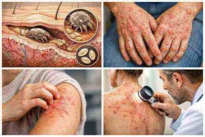 immagine scabbia acaro